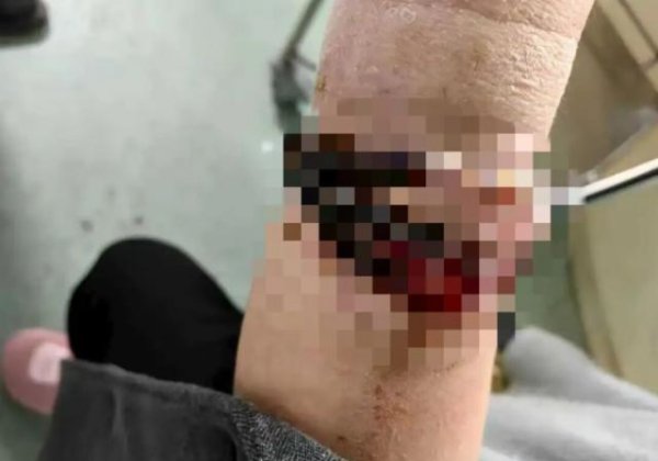 盛鹏配资 女子手镯10年没摘竟“长”进肉里！医生：再迟就保不住了